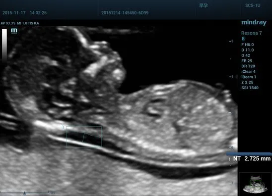 Клинические изображения УЗИ аппарат Mindray Resona 7