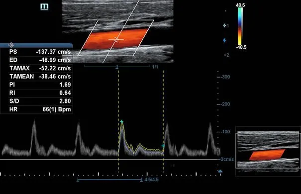 Клинические изображения УЗИ аппарат Mindray DC-70 Exp