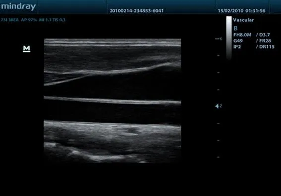 Клинические изображения УЗИ аппарат Mindray DP-50 портативный