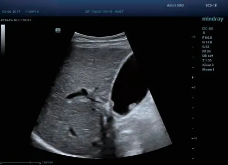 Клинические изображения УЗИ аппарат Mindray DC-80 Exp