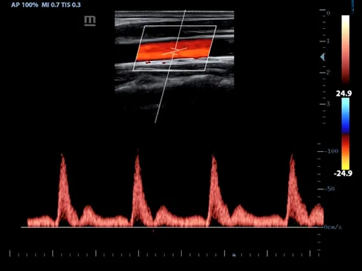 Клинические изображения УЗИ аппарат Mindray Z60 портативный