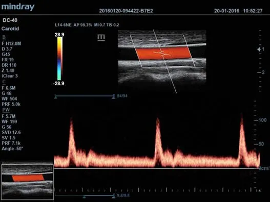 Клинические изображения УЗИ аппарат Mindray DC-40 Exp