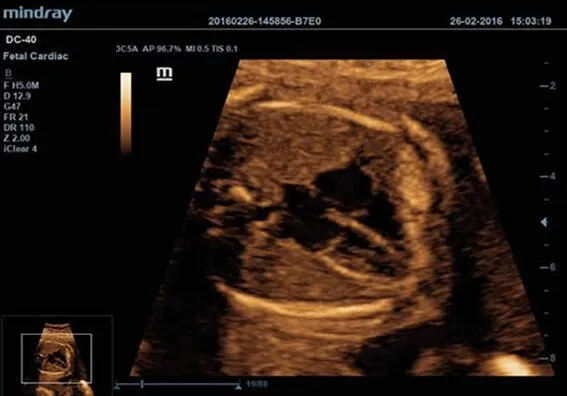 Клинические изображения УЗИ аппарат Mindray DC-40 Exp