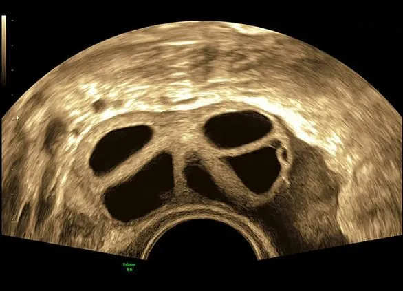 Клинические изображения Ультразвуковая диагностическая система GE HealthCare Voluson E6