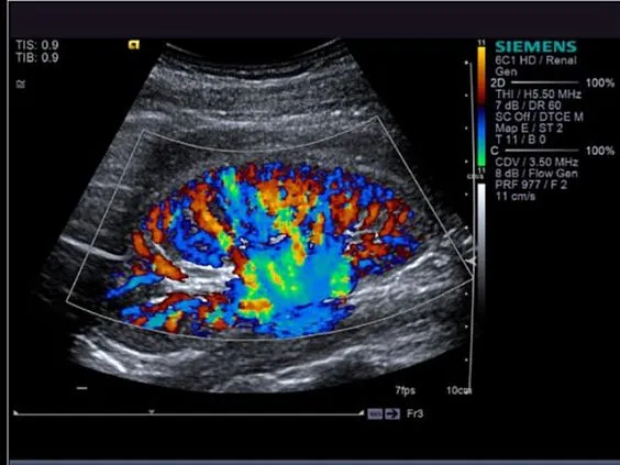 Клинические изображения Siemens Acuson S3000 ультразвуковая система