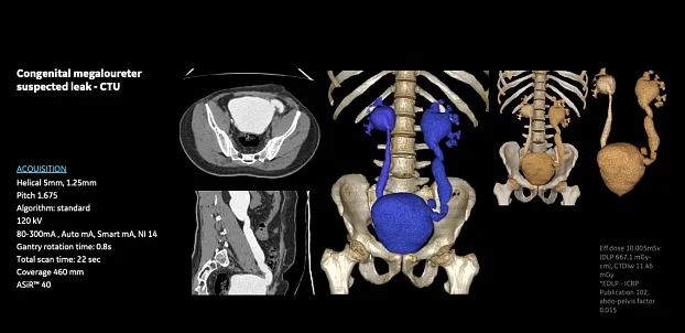 КТ-урография после операции
