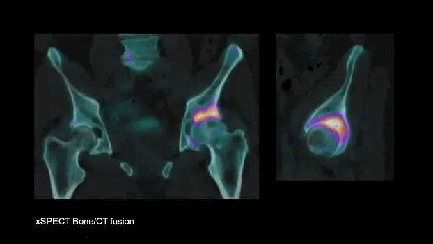 Клинические изображения Siemens Symbia Intevo Bold КТ аппарат 