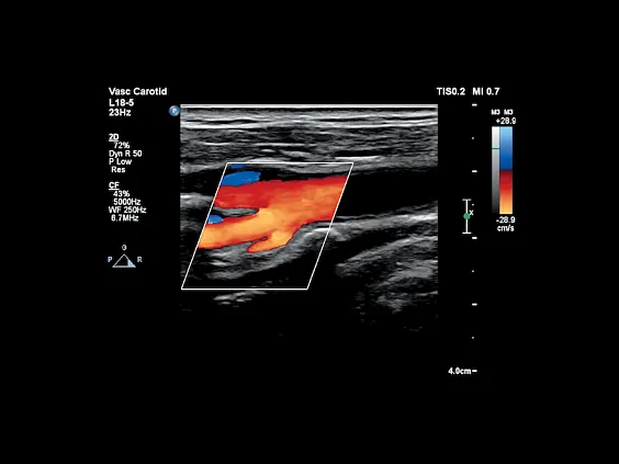 Клинические изображения Philips Affiniti 70 ультразвуковой аппарат