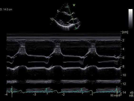 Клинические изображения Ультразвуковая диагностическая система GE Vivid S60