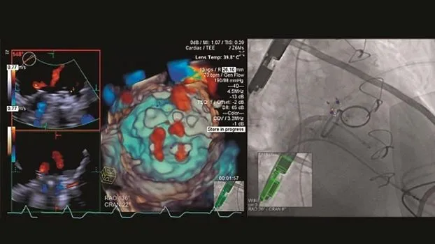 Клинические изображения Siemens Acuson SC2000 ультразвуковая система