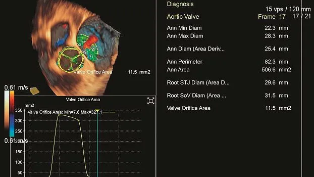 Клинические изображения Siemens Acuson SC2000 ультразвуковая система