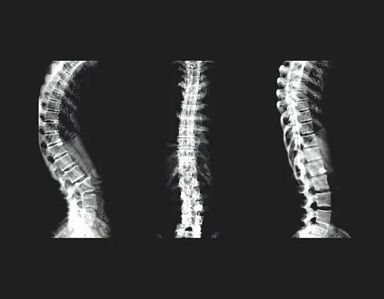 Клинические изображения Рентгеновский денситометр GE Lunar iDXA