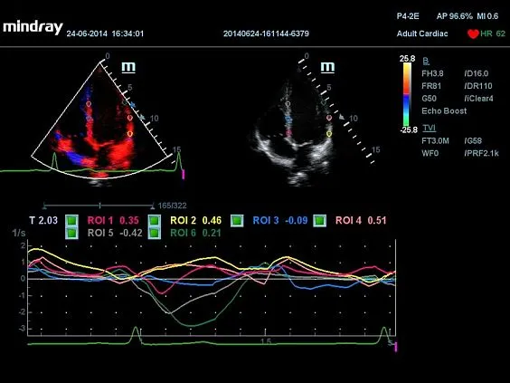 Клинические изображения УЗИ аппарат Mindray DC-70 Pro X-insight