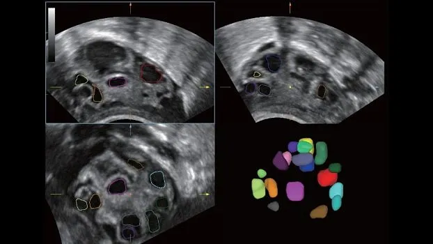 Клинические изображения УЗИ аппарат Mindray DC-40 Pro