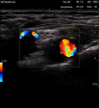 Клинические изображения GE Venue 50 аппарат УЗИ портативный