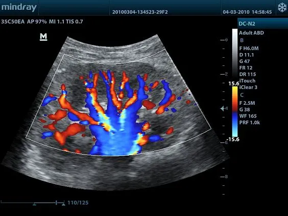 Клинические изображения УЗИ аппарат Mindray DC-N2