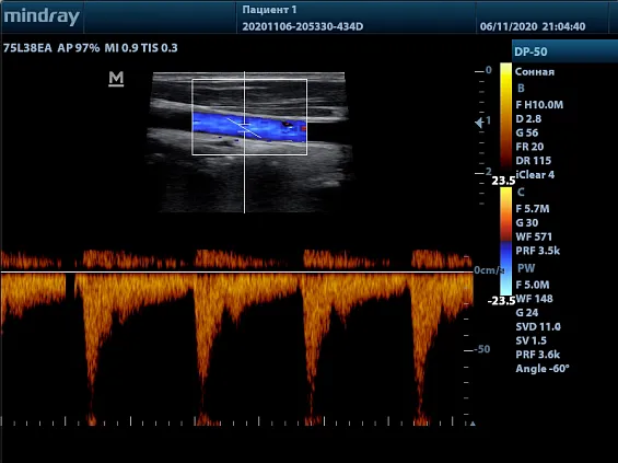 Клинические изображения УЗИ аппарат Mindray DP-50 Color портативный