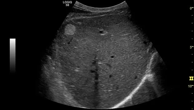 Клинические изображения GE Logiq S8 XDclear ультразвуковая диагностическая система