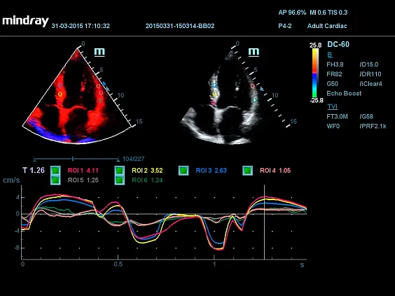 Клинические изображения УЗИ аппарат Mindray DC-60 Exp