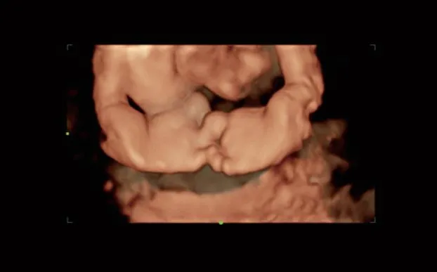 Клинические изображения УЗИ аппарат Mindray Imagyn I9