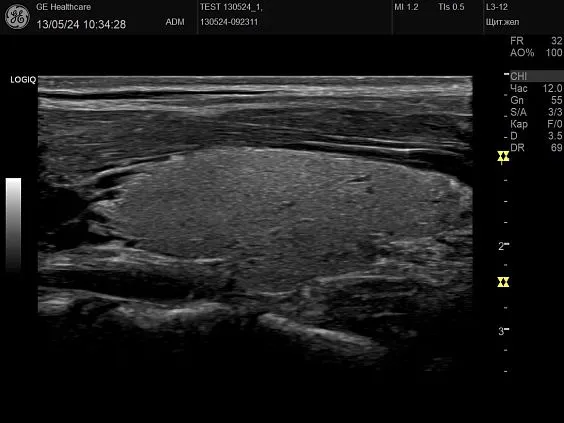 Клинические изображения GE HealthCare Logiq P10 ультразвуковой аппарат