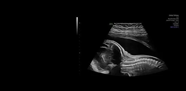 Клинические изображения УЗИ аппарат GE HealthCare Voluson Expert 22