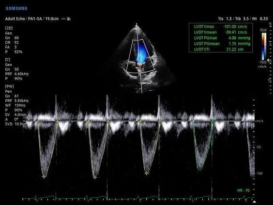 V6-RUS: Выносящий тракт левого желудочка, HeartAssist