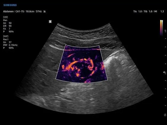 Клинические изображения Samsung Medison V7 УЗИ аппарат