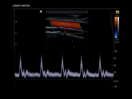 Клинические изображения Samsung Medison HM70 EVO УЗИ аппарат портативный
