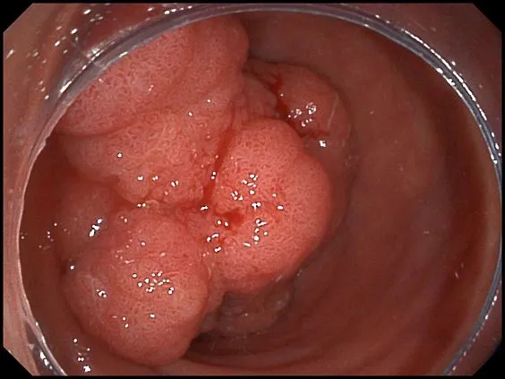 Клинические изображения SonoScape HD-350 видеоэндоскопическая система