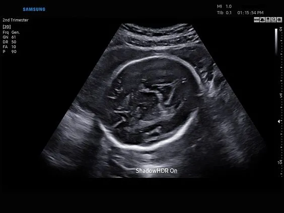 Клинические изображения Samsung Medison W9 УЗИ аппарат