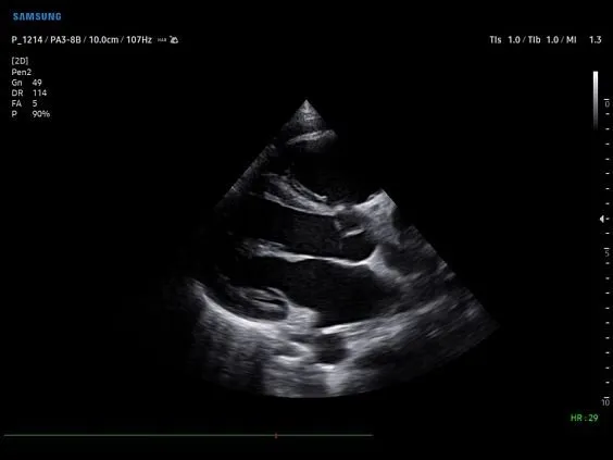 Клинические изображения Samsung Medison V8 УЗИ аппарат