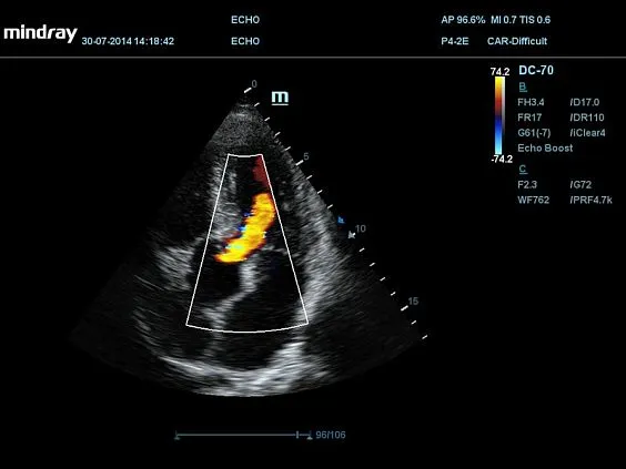 Клинические изображения УЗИ аппарат Mindray DC-70 Pro X-insight