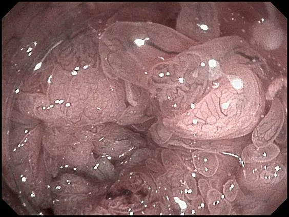 Клинические изображения SonoScape HD-320 видеоэндоскопическая система