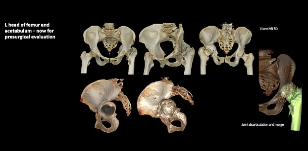 КТ костей таза