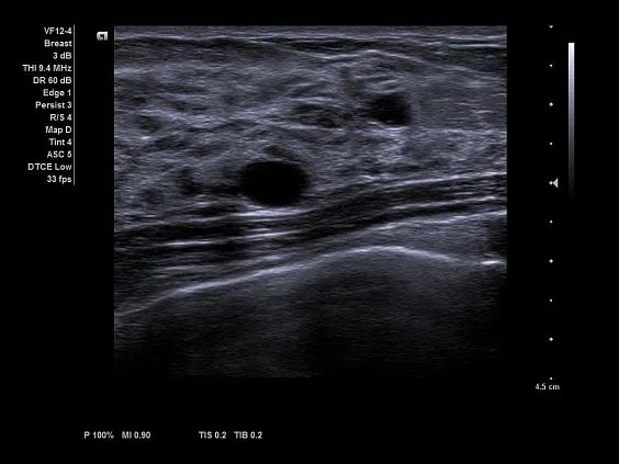 Клинические изображения Ультразвуковая система Siemens Acuson NX3