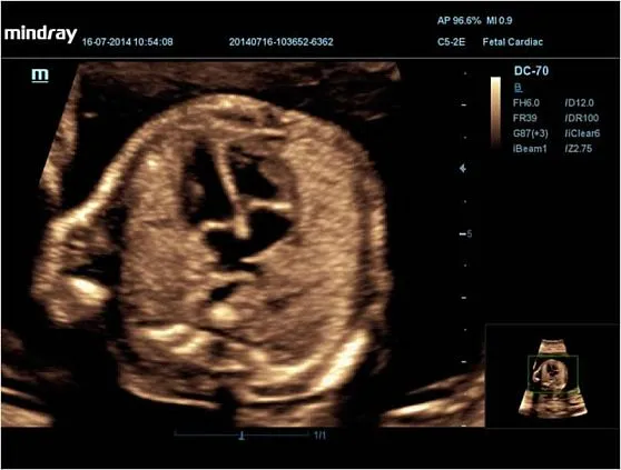 Клинические изображения УЗИ аппарат Mindray DC-70 Pro X-insight