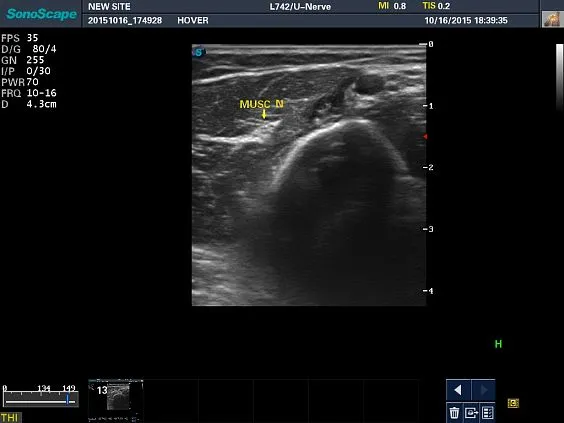 Клинические изображения Sonoscape S8 Exp ультразвуковой аппарат