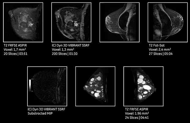 Клинические изображения МРТ аппарат GE SIGNA Pioneer 3T