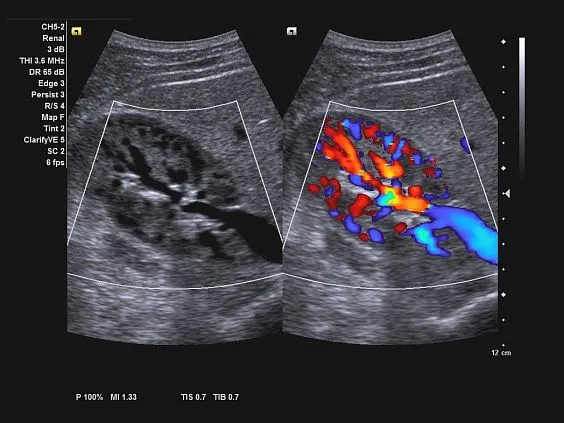 Клинические изображения Ультразвуковая система Siemens Acuson NX3