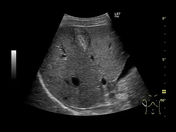 Клинические изображения Ультразвуковая диагностическая система GE Logiq S7 XDclear