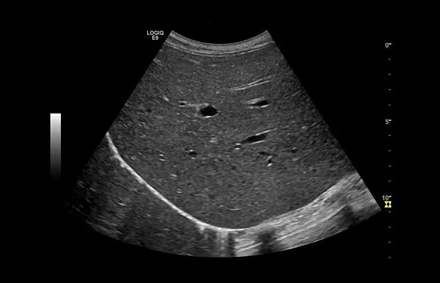 Клинические изображения УЗИ аппарат GE Healthcare Logiq E9 XDclear