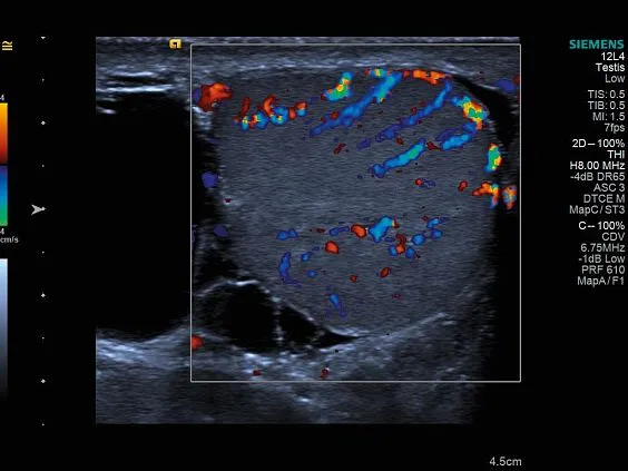 Клинические изображения Siemens Acuson S1000 ультразвуковая система