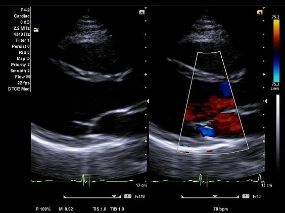Клинические изображения Siemens Acuson NX2 Elite аппарат УЗИ