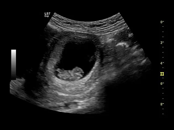 Клинические изображения Ультразвуковая диагностическая система GE Logiq S7 XDclear