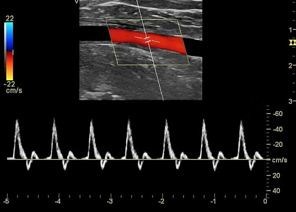 Клинические изображения Ультразвуковая диагностическая система GE Logiq V5