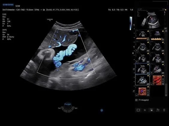 V6-RUS: Пуповина плода, MV-Flow