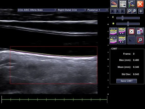 Клинические изображения Siemens Acuson NX2 Elite аппарат УЗИ