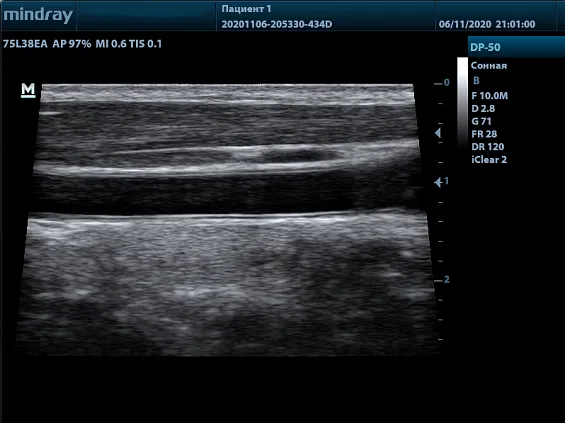 Клинические изображения УЗИ аппарат Mindray DP-50 Color портативный