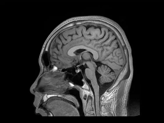 Клинические изображения МРТ аппарат GE SIGNA Explorer 1.5T